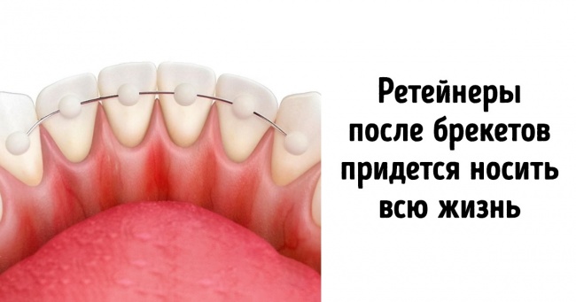 11 самых популярных вопросов о брекетах, ответы на которые стоит узнать перед их установкой Интересное
